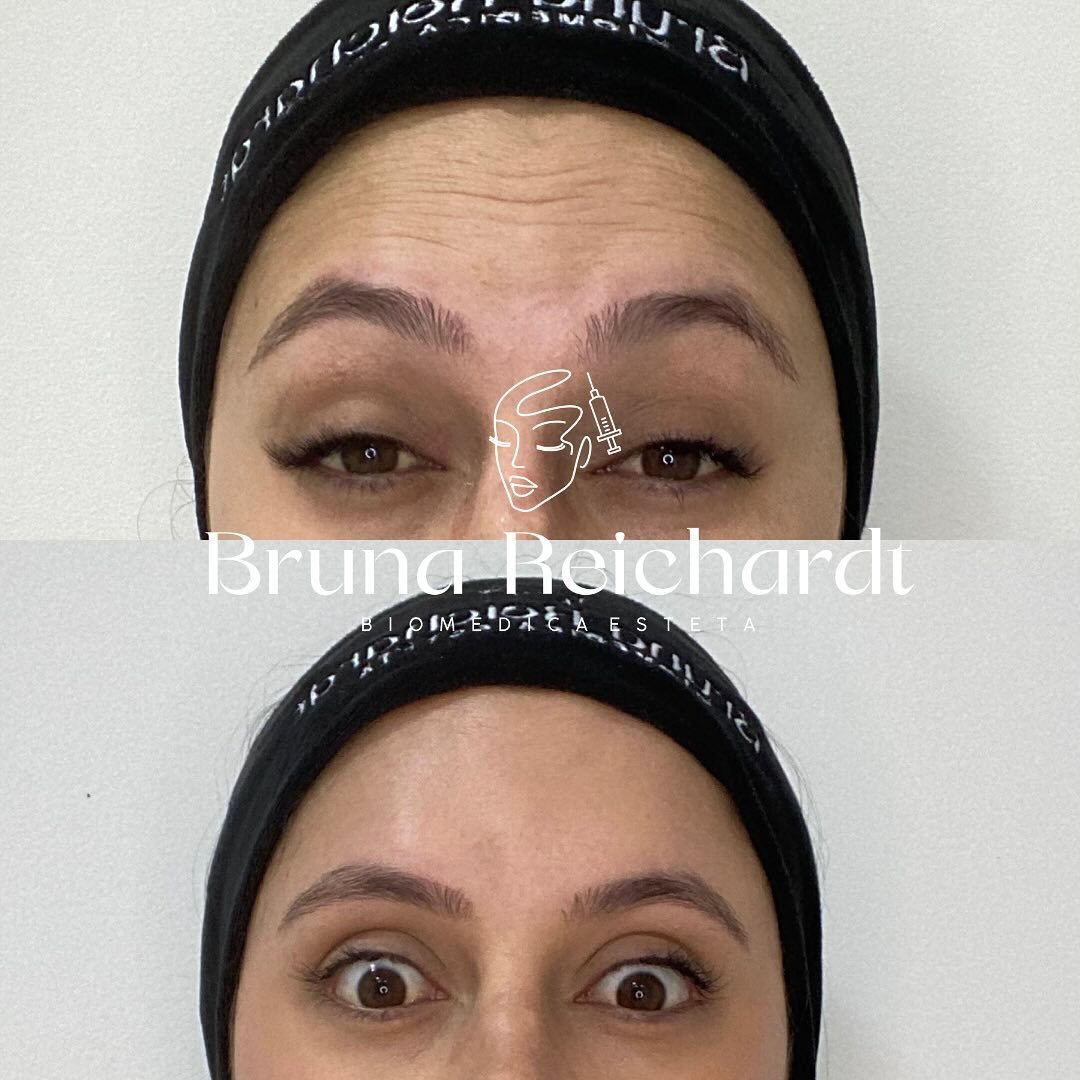 Antes e depois de toxina botulínica na testa