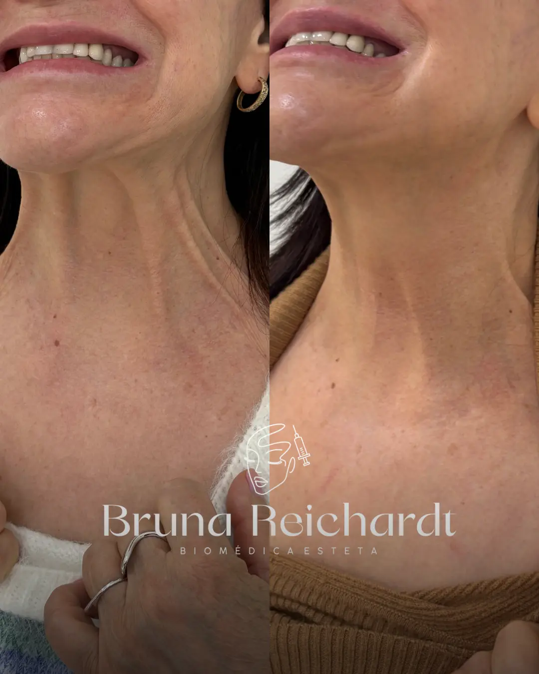 Antes e depois de toxina botulínica no pescoço, técnica Nefertiti