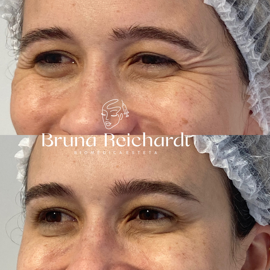 Antes e depois de toxina botulínica na região dos olhos
