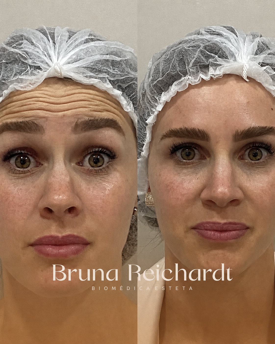 Antes e depois de toxina botulínica na testa e glabela